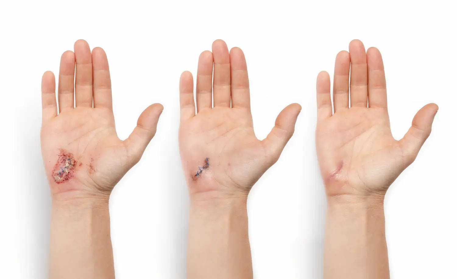 three hands showing progression of how to heal wounds faster naturally