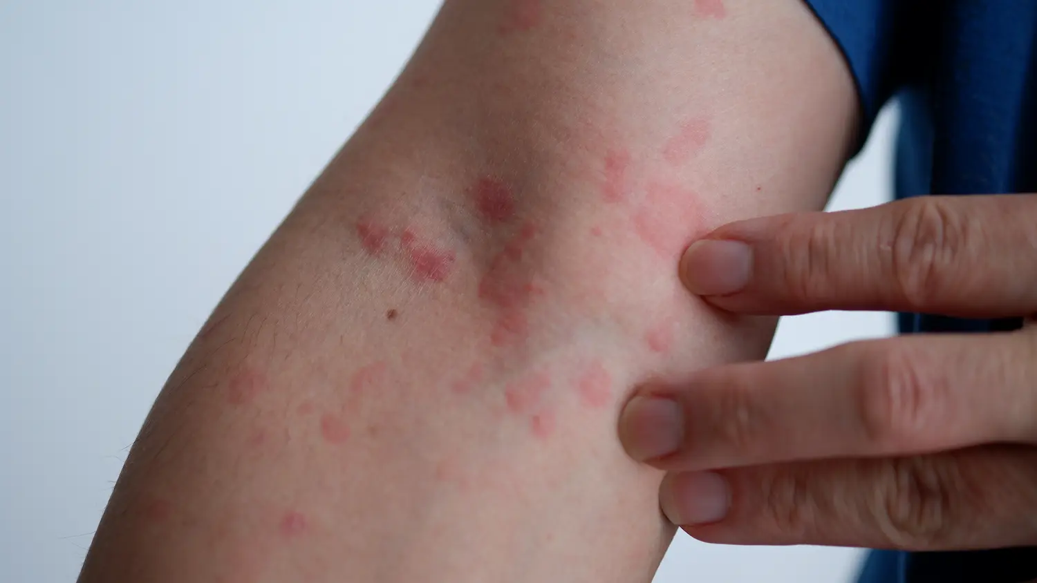 a person taking skin infection antibiotics