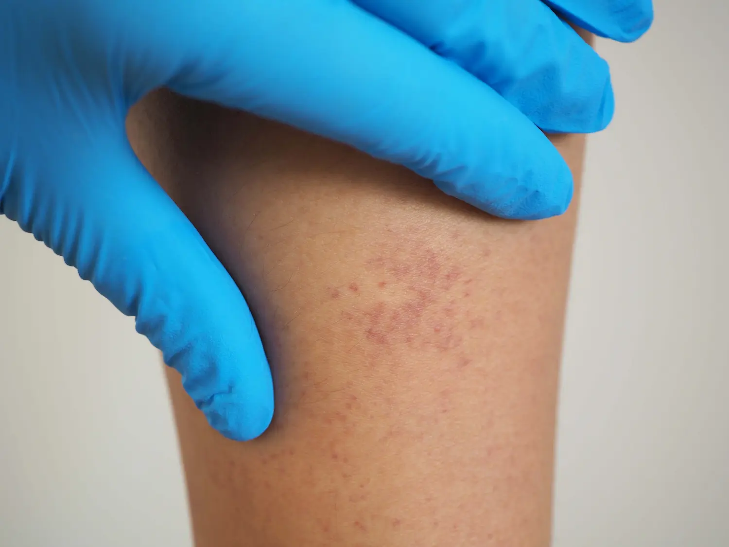 a patient with lupus asking what kind of doctor treats lupus