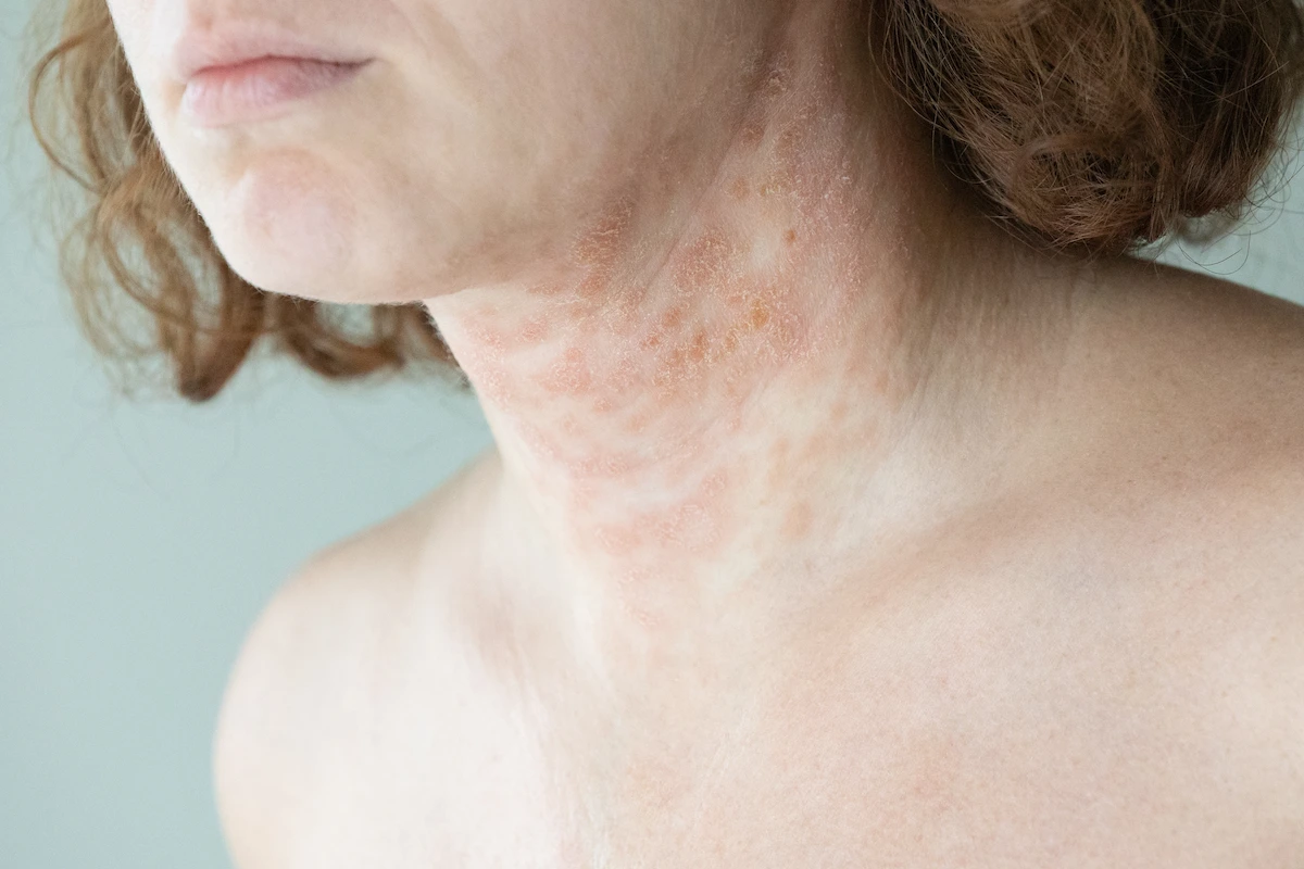A woman with eczema on neck
