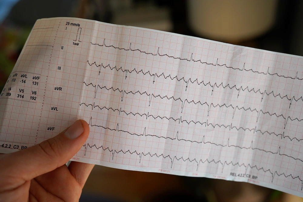 afib-with-rvr A chart showing afib with rvr