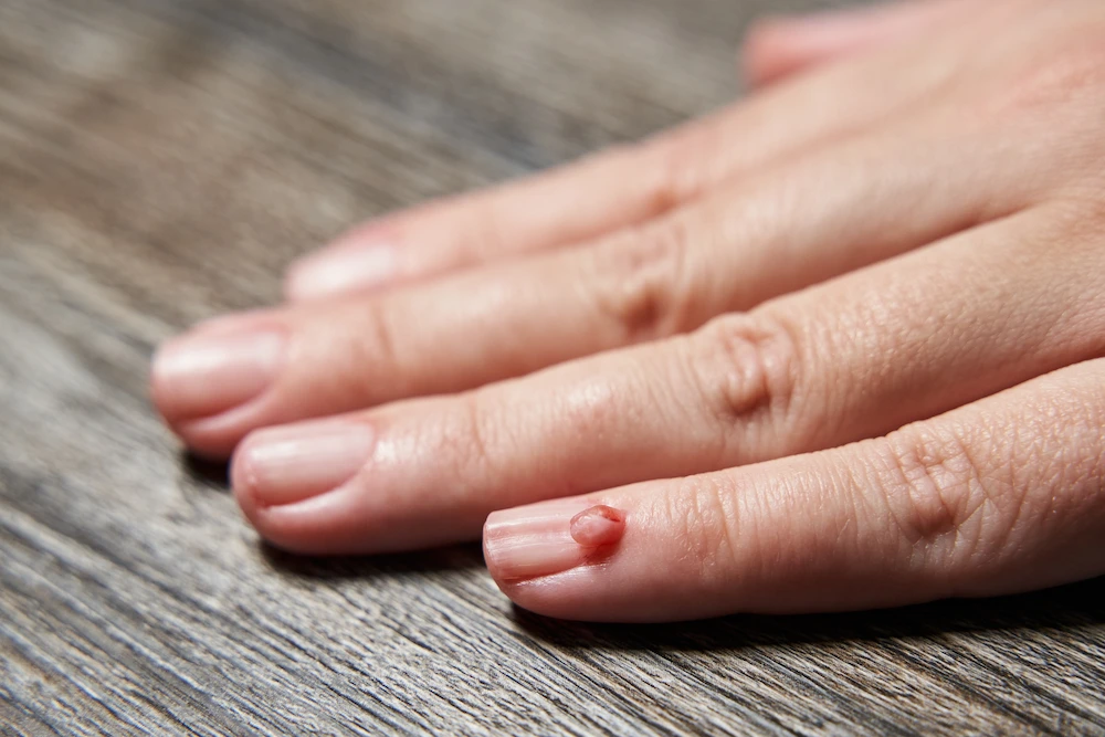 periungual-warts periungual warts