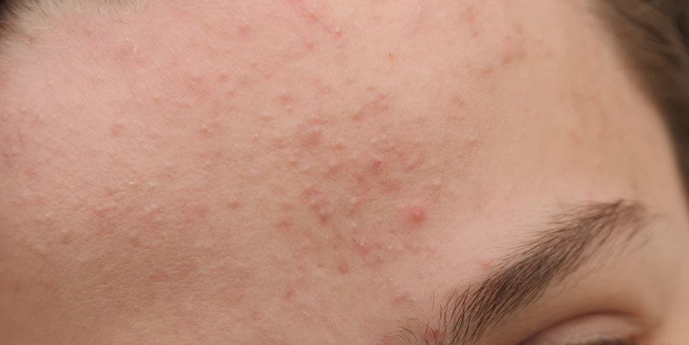 A woman with small bumps on forehead