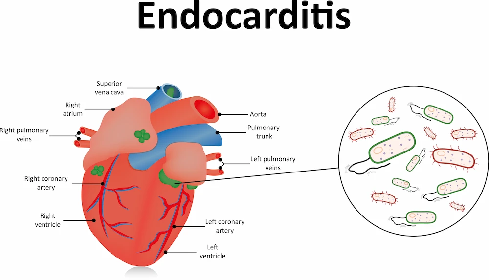 what is endocarditis