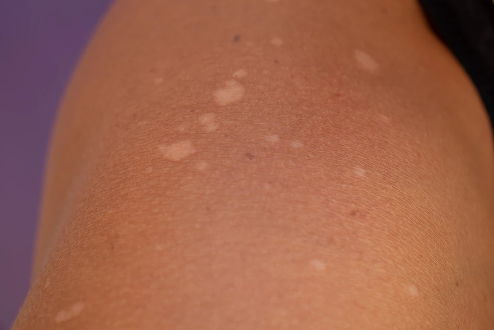 white spots on skin
