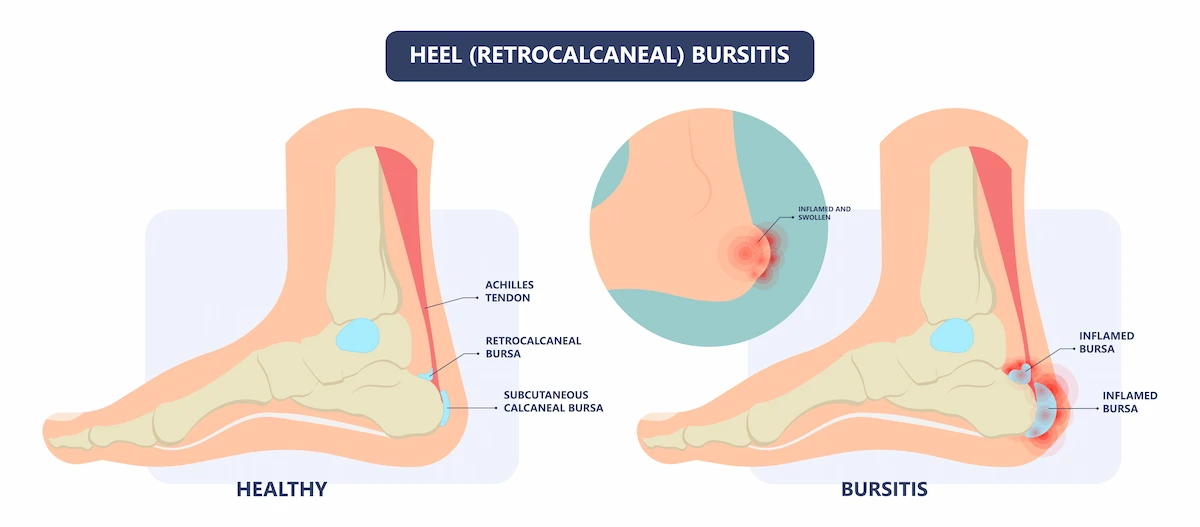 achilles bursitis chart