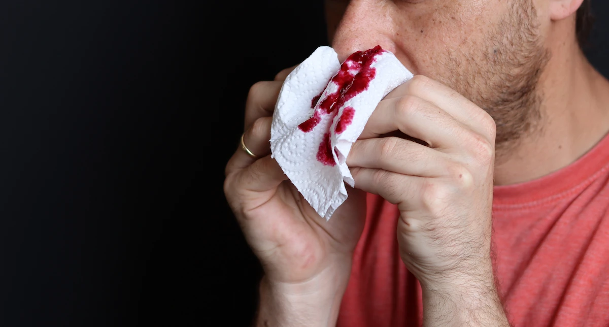 Can stress cause nosebleeds