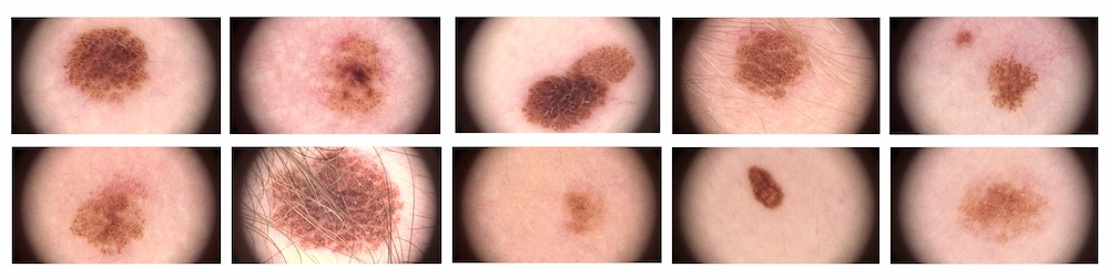 non-cancerous moles in miami