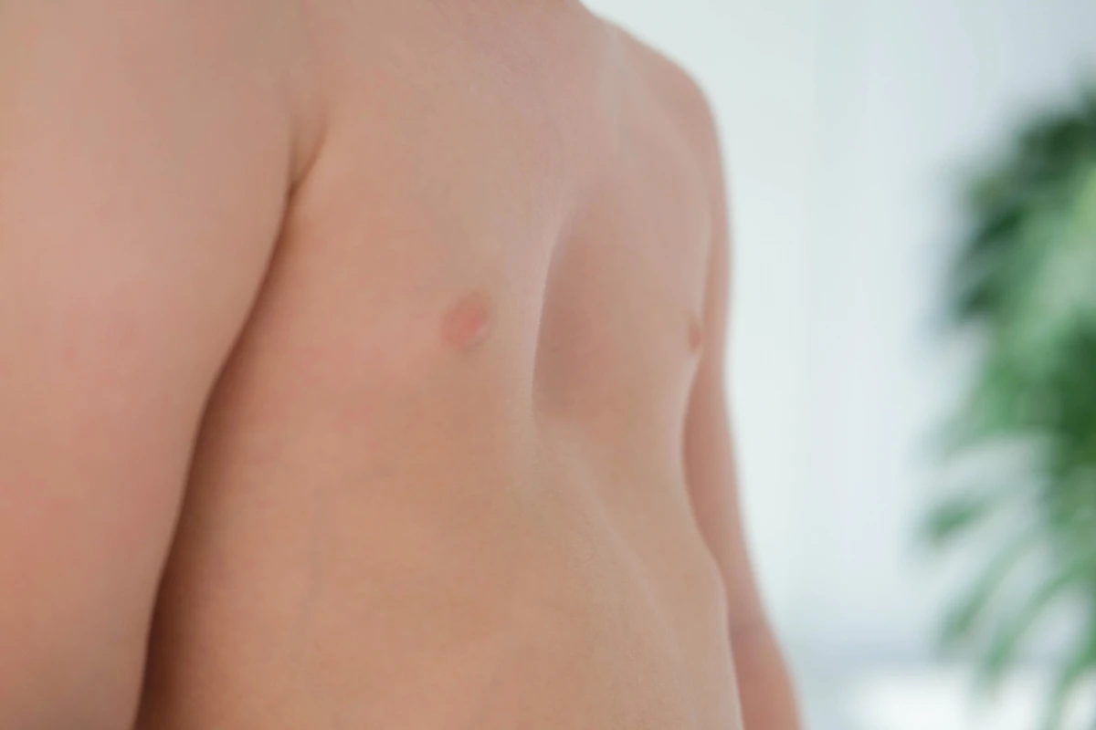 pectus excavatum treatments