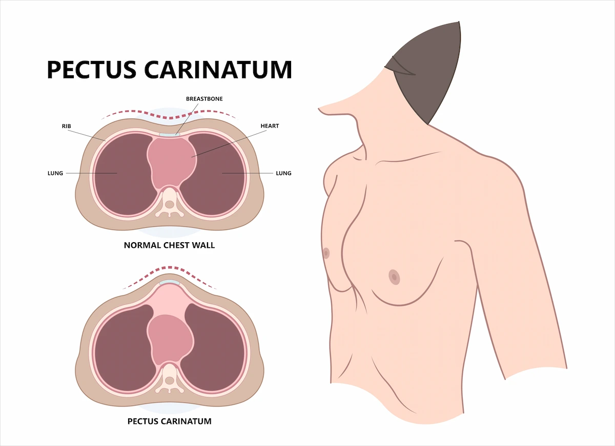 pectus excavatum woman