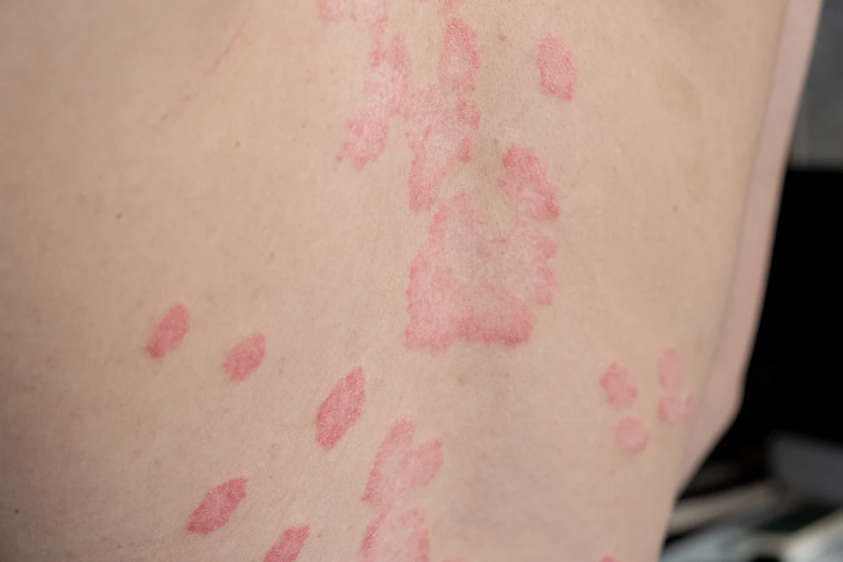 psoriasis symptoms in miami