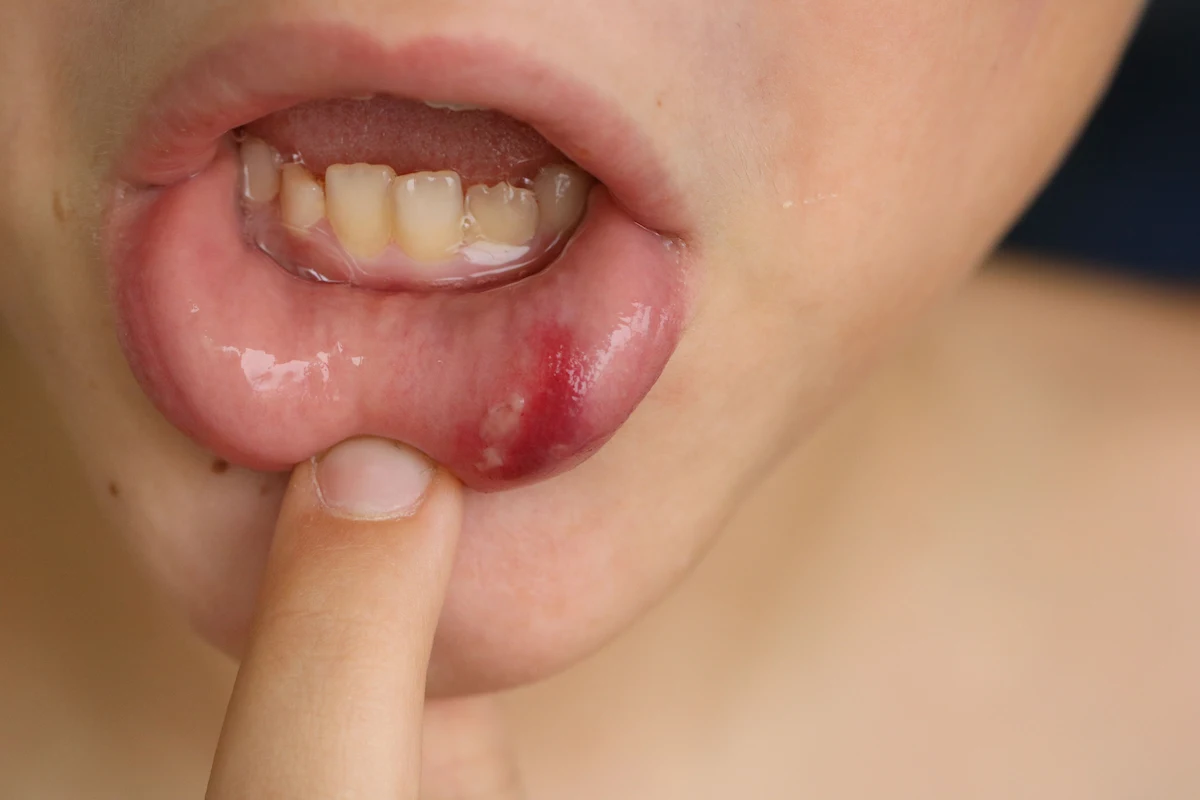 Cheek and lip biting in Miami