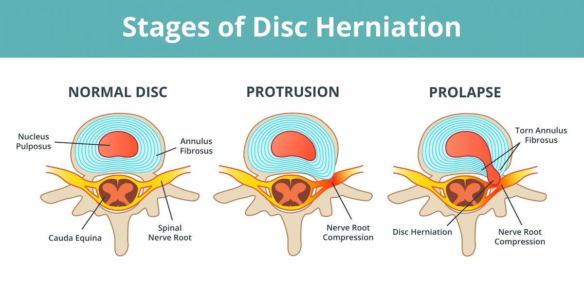 disc extrusion vs protrusion