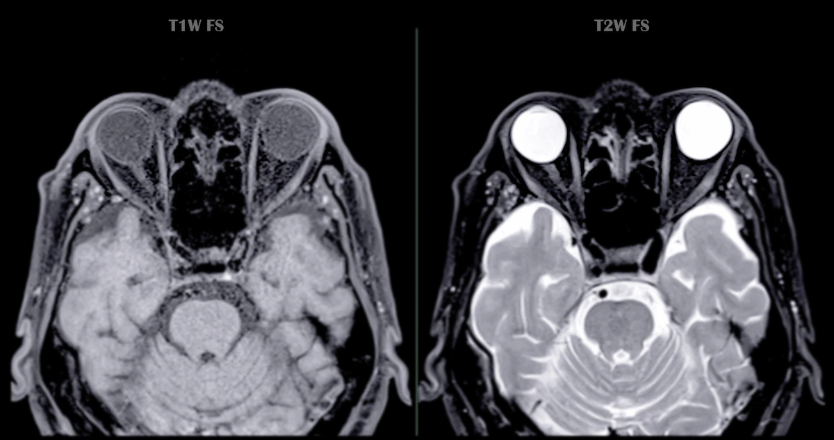 mri-with-contrast MRI with contrast example