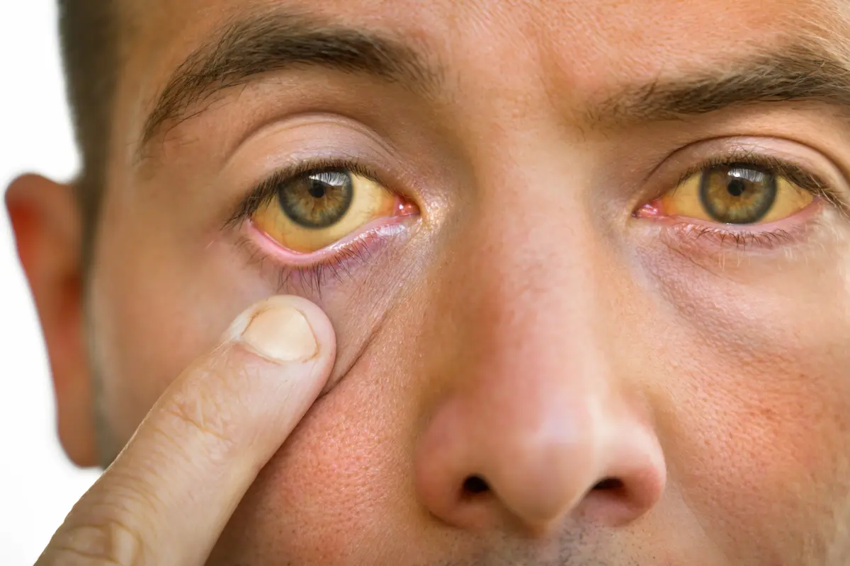 causes of scleral icterus