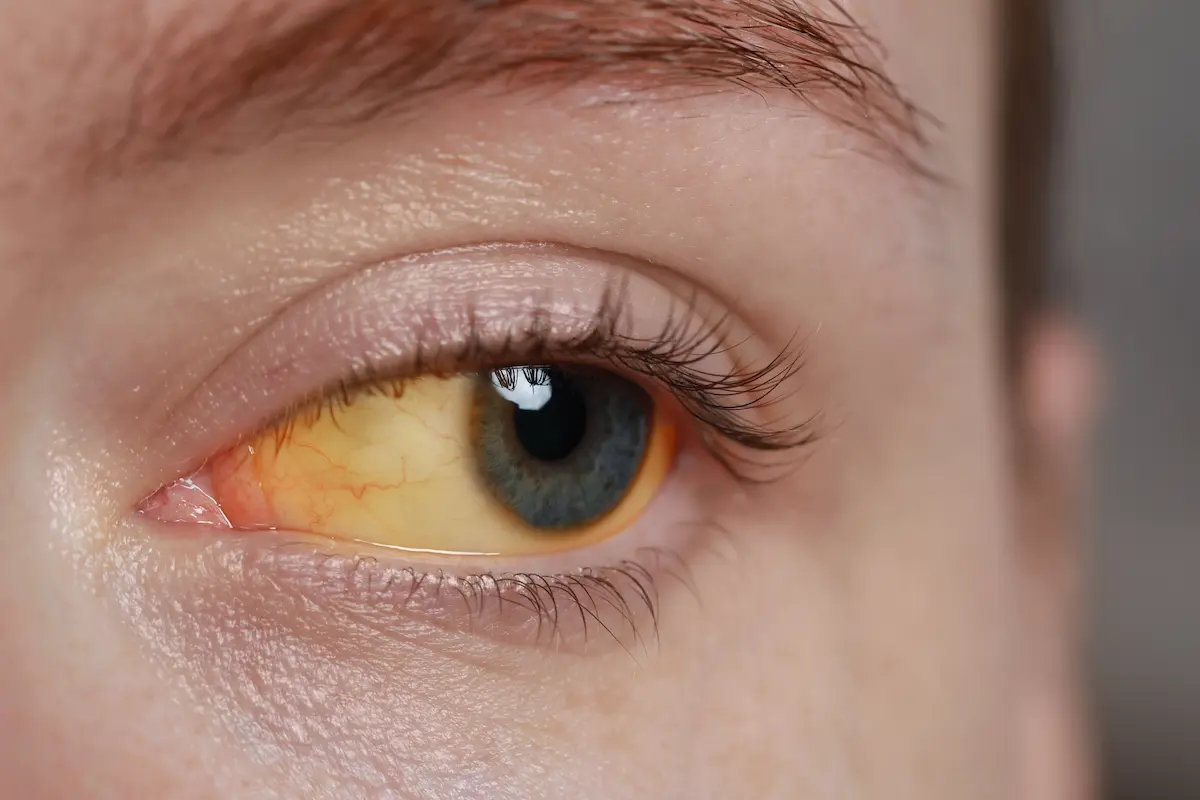 what-is-scleral-icterus what is scleral icterus