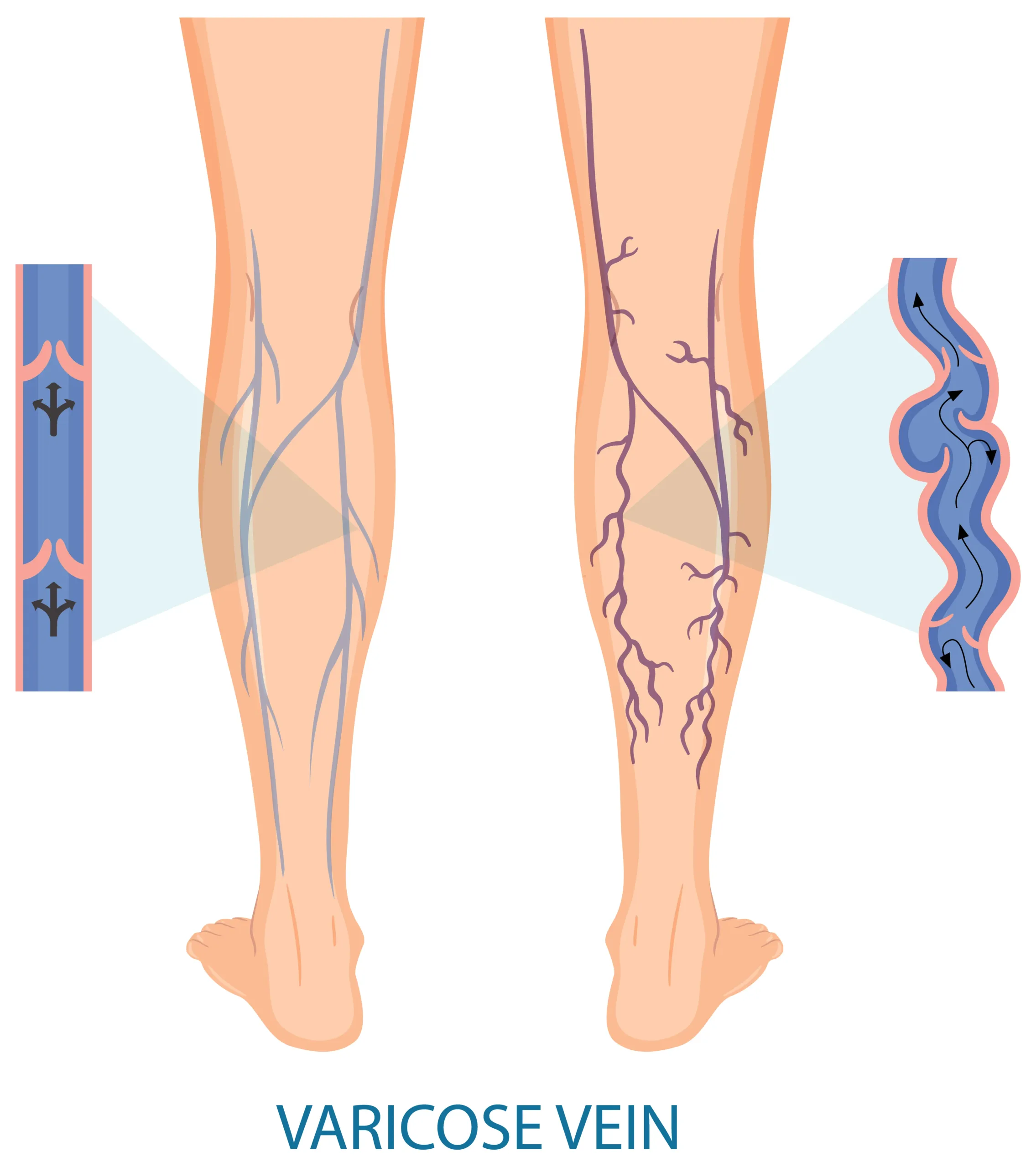 image showing the difference between standard veins and varicose veins