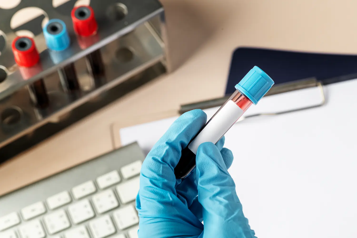 a doctor holding an autoimmune blood test