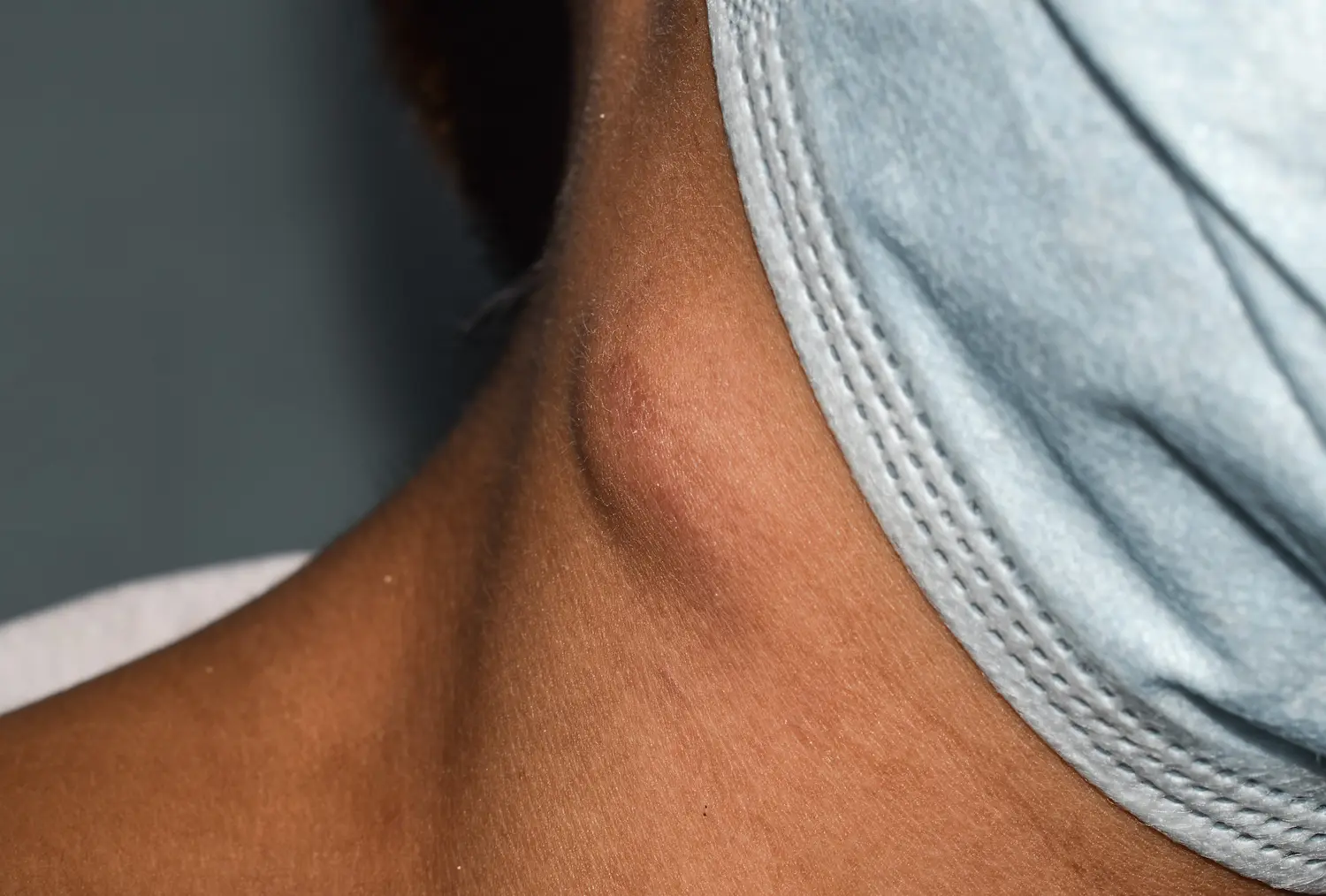 a woman with adenitis or swollen lymph nodes in stomach and neck