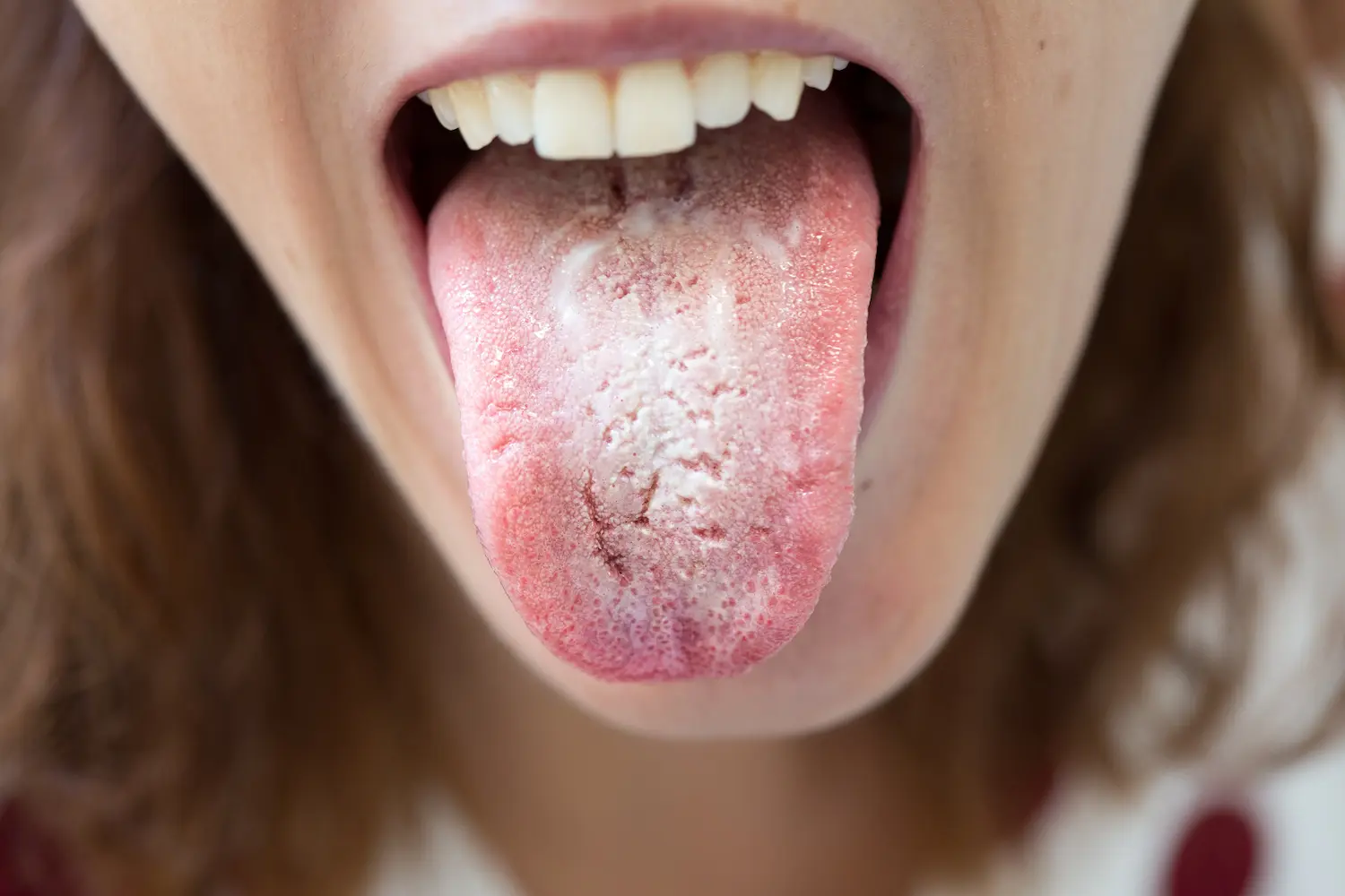 a woman with chlamydia bumps on tongue