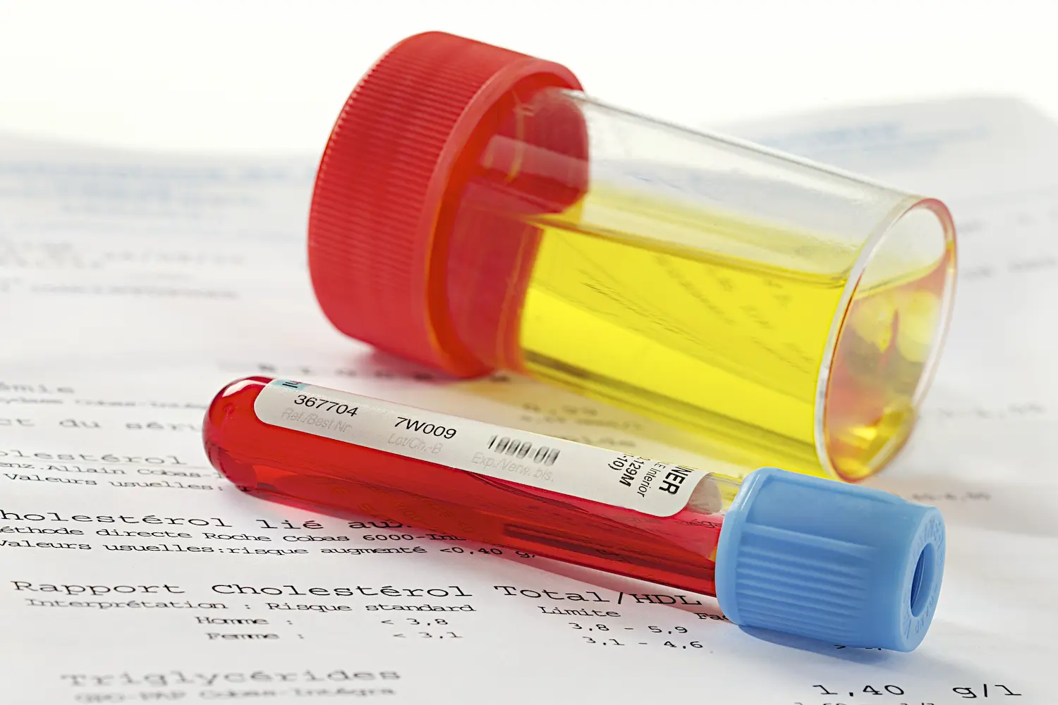 a test to determine HIV urine symptoms