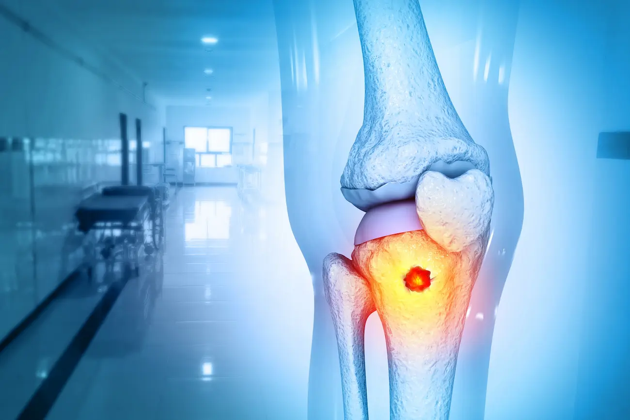 how long can you have bone cancer without knowing