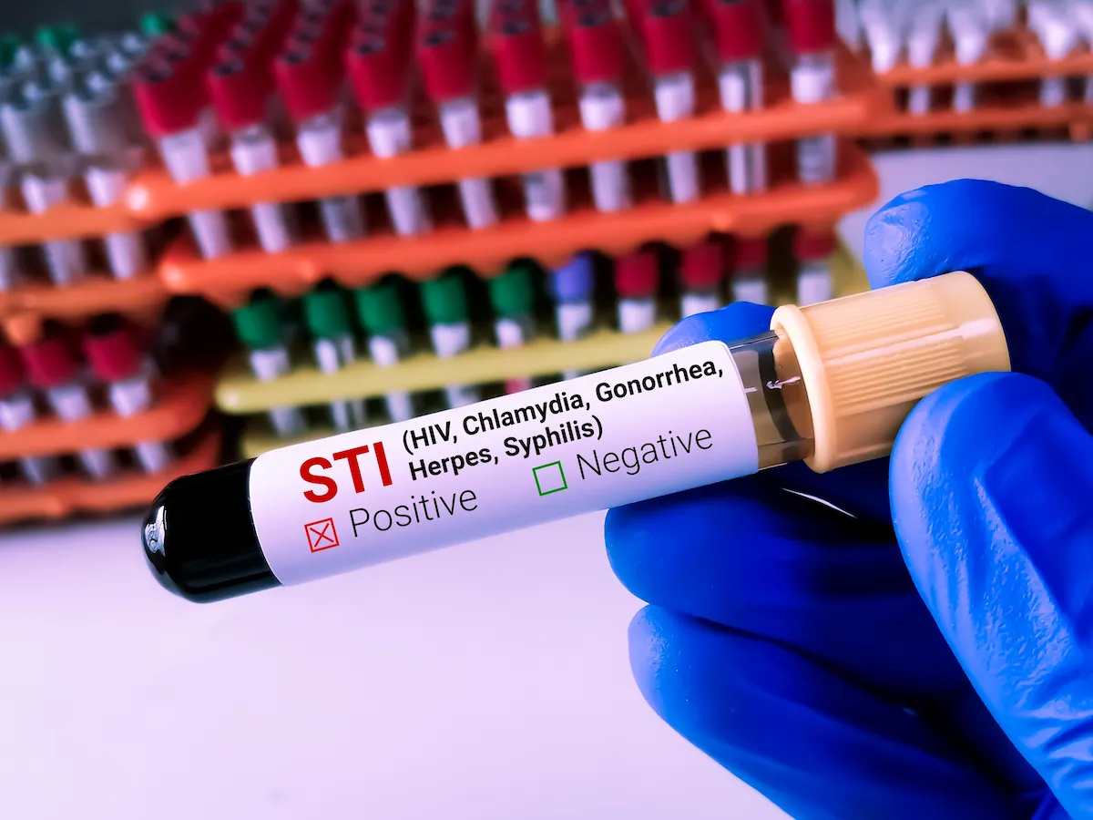 an STI blood test for how to cure chlamydia without going to the doctor