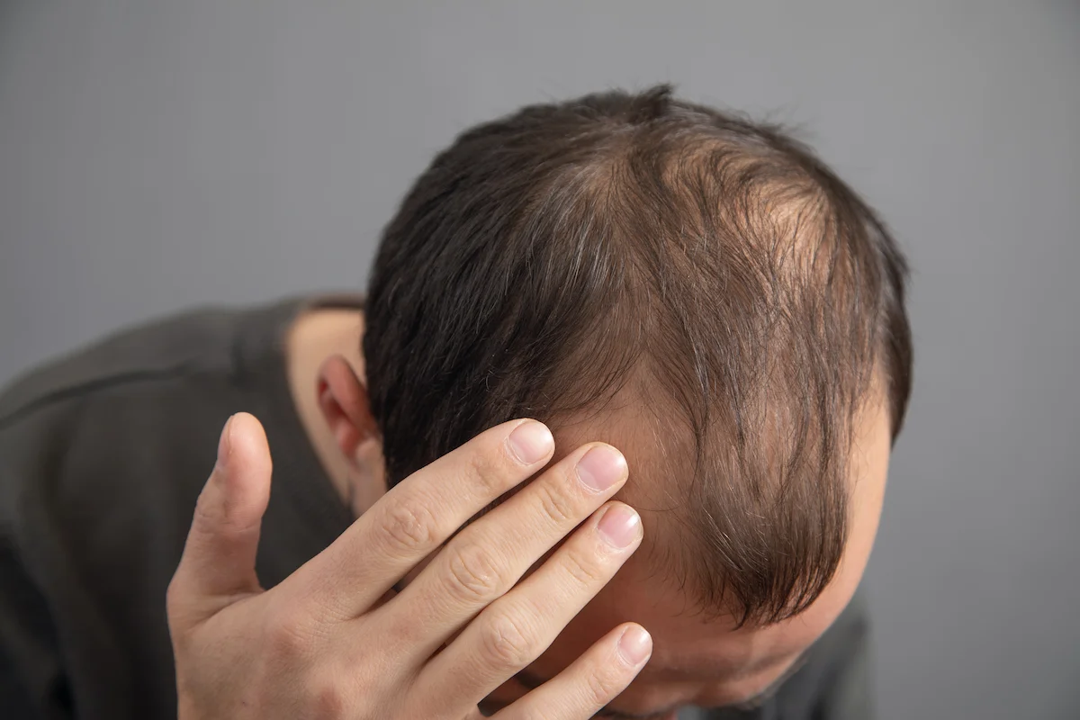 a man wondering does low testosterone cause hair loss