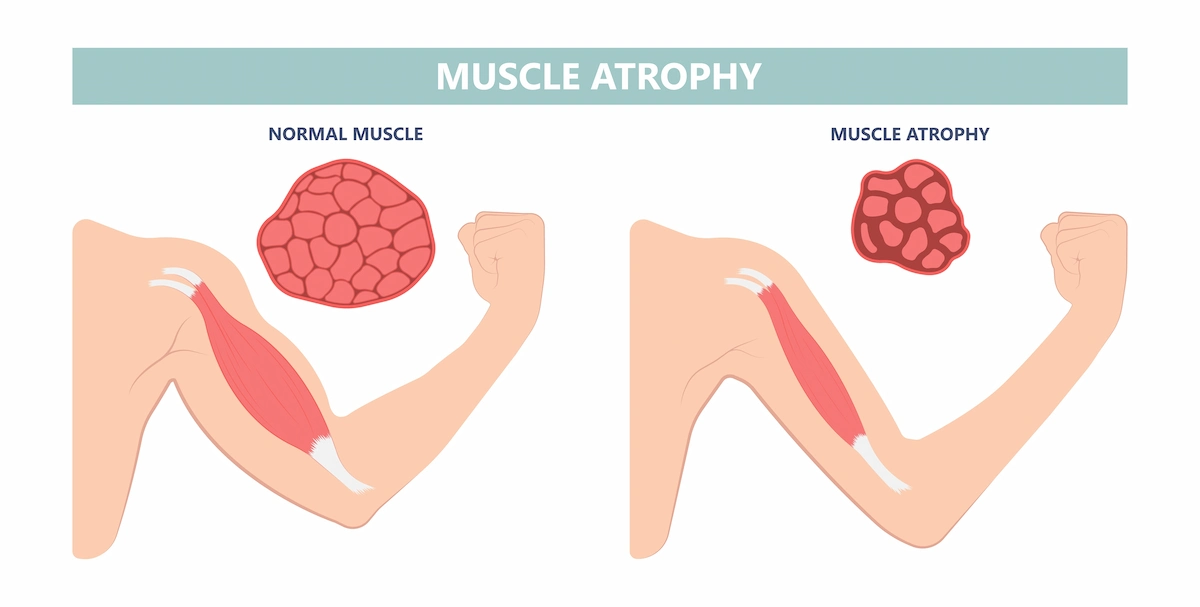 showing what are the signs of disuse syndrome