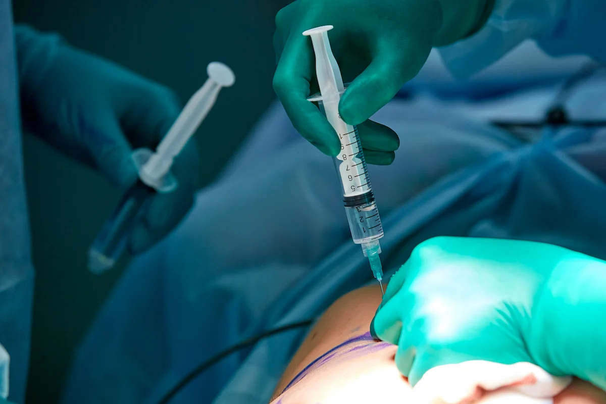 local anesthesia vs general anesthesia