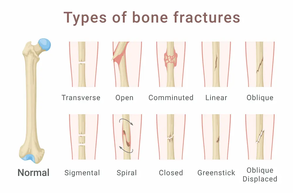 a chart showing the difference between fracture vs break