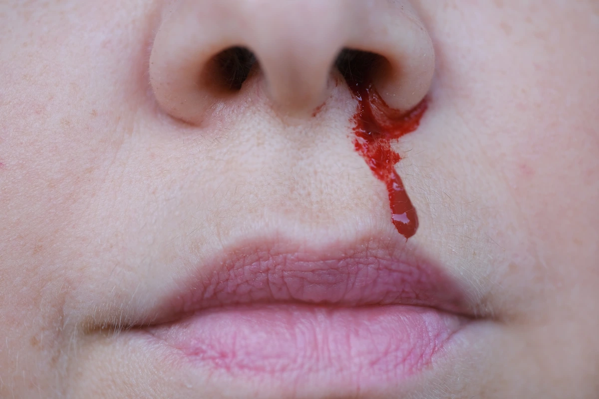 does-high-blood-pressure-cause-nosebleeds Does high blood pressure cause nosebleeds