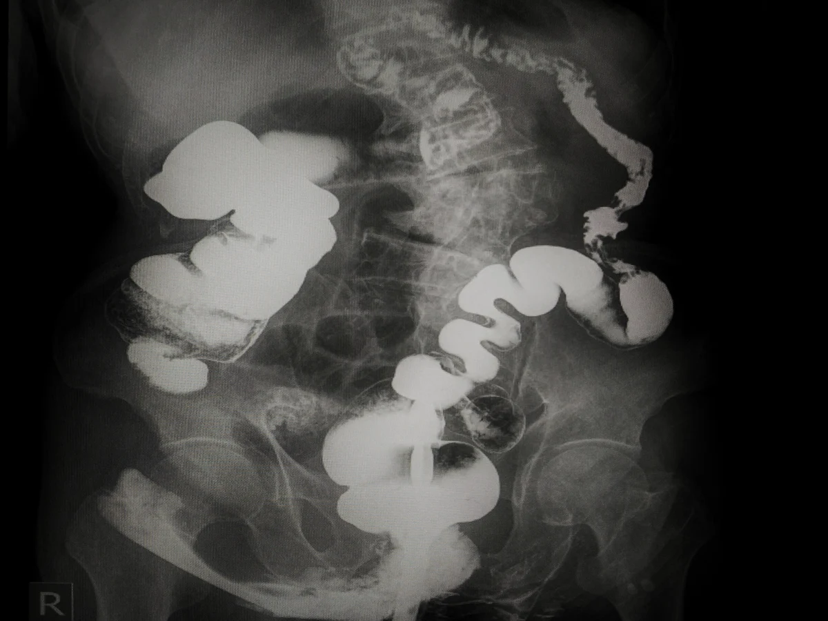 lower GI bleed in Miami